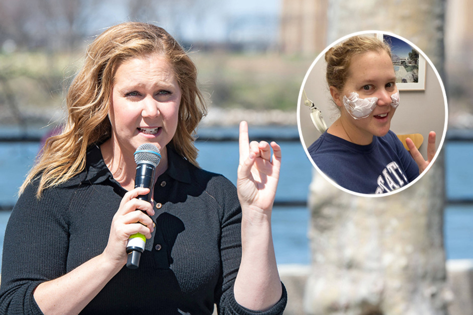 "I looked like Maleficent": Amy Schumer gets cheek fillers dissolved!