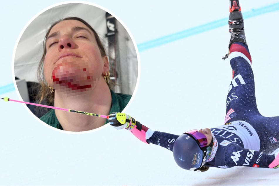 Ski-Star verliert bei Sturz ihren Helm: So schlimm sieht ihr Gesicht aus