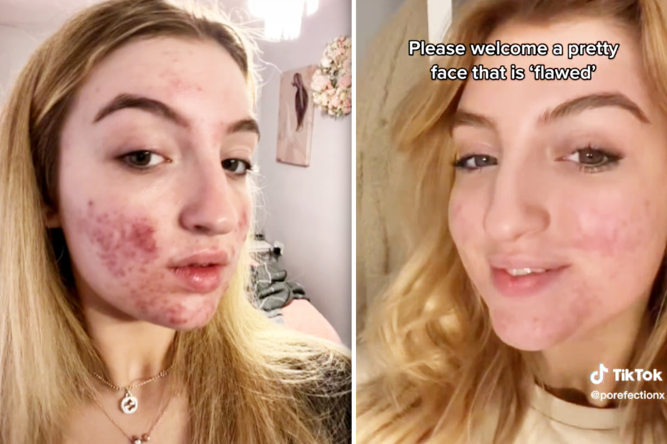 Teenagerin von TikTok gesperrt! Akne-Videos sind "grausamer Inhalt"!